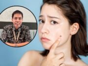 Kenali Jenis-jenis Tahi Lalat